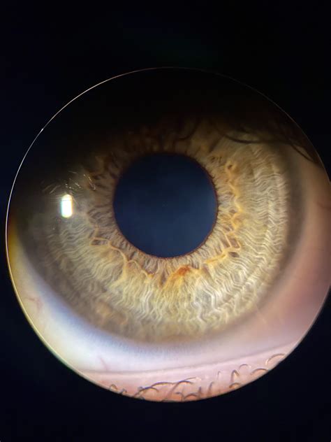 This picture my eye doctor took of my eye : r/mildlyinteresting