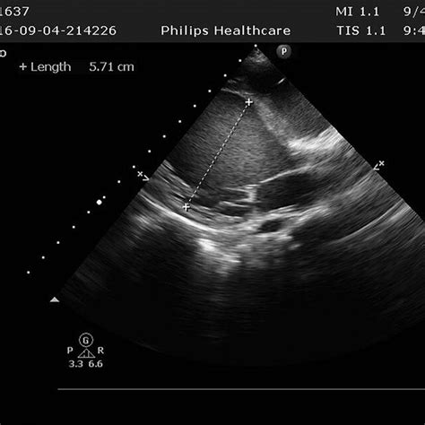 The left ventricle was significantly enlarged 5.71 cm. | Download ...