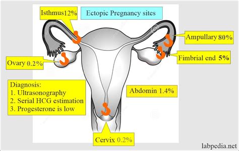 Ectopic Pregnancy Sites Hot Sex Picture