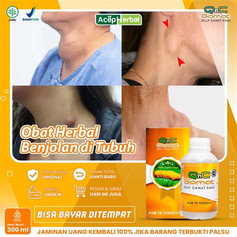 Jual Obat Benjolan Di Leher Kelenjar Getah Bening Lipoma Uci Uci