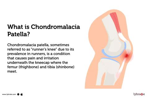 Chondromalacia Patella Causes Treatment | atelier-yuwa.ciao.jp