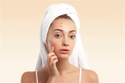 5 Best Acne Treatments Safest And Most Effective