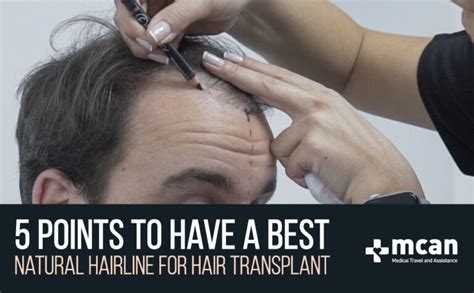 All Tips About Getting Best Hairline For Hair Transplant