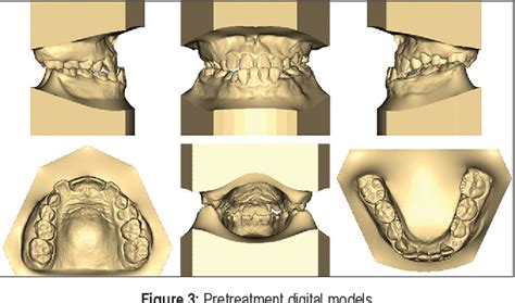 Figure 3 From Successful 2 Phase Treatment Of Growing Skeletal Class