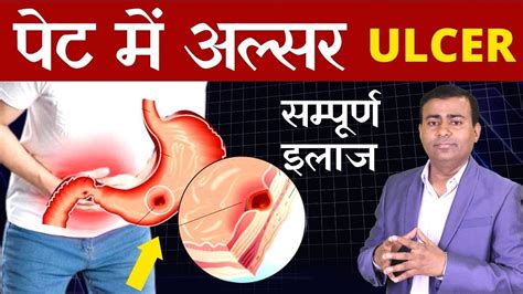 पेट में अल्सर सम्पूर्ण इलाज Peptic Ulcer Gastric Ulcer Ulcers Treatment Duodenal Hindi Youtube