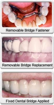 Fixed Dental Bridge - Ocotillo Dental Care | Dentist Chandler, AZ