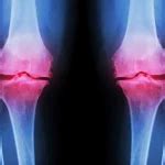 Knie Arthrose Epigenetik Und Gesundheit