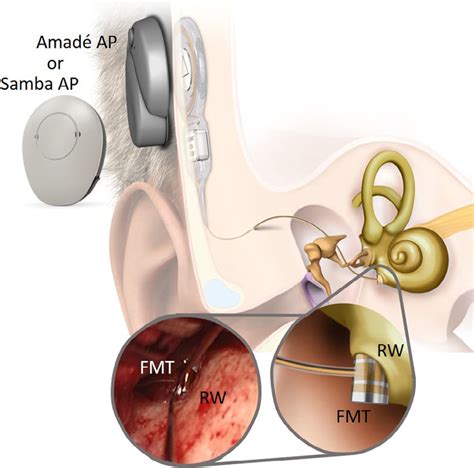 The Vibrant Soundbridge Including The Floating Mass Transducer Fmt Download Scientific