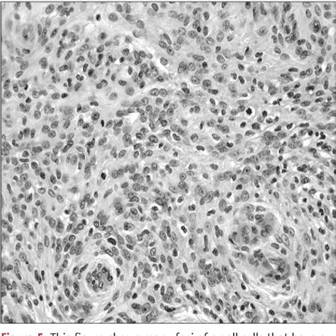 Figure From Anaplastic Meningioma Presenting As A Left Parietal Mass