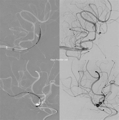 Intracranial Atherosclerosis MCA Stent Occlusion and Re-Stenting ...