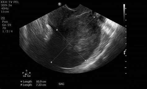 Uterine Fibroid Or Ovarian Fibroma Importance Of Comprehensive