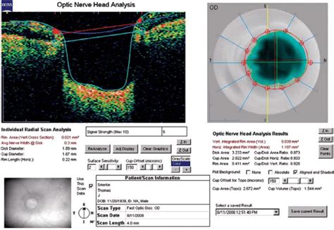 Fast optic nerve head scan of right eye of case 1, showing near total ...