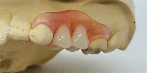 Nesbit Flexible Partial Denture – Dental Lab Direct