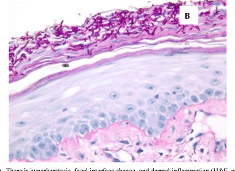 [pdf] A Case Of Tinea Incognito Semantic Scholar