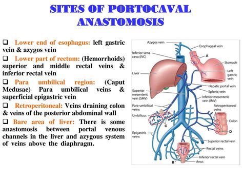 Portacaval Anastomosis