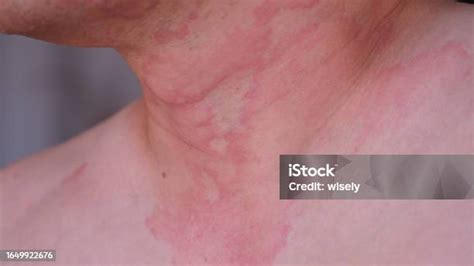 Close Up Image Of Skin Texture Suffering Severe Urticaria Or Hives Or