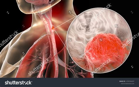 Esophageal Cancer 3d Illustration Showing Malignant Stock Illustration