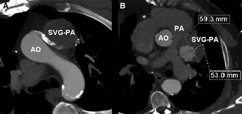 Saphenous Vein Graft Pseudoaneurysm Causing External Compression Of The