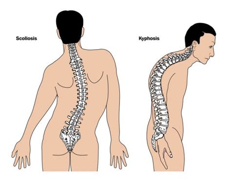 Lordosis Cause Symptoms Diagnosis Treatment Exercise