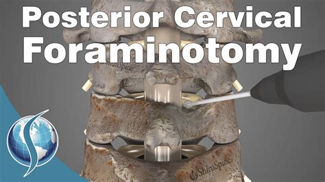 Lumbar Foraminotomy