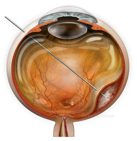 Surgical Subretinal Injection For Gene Therapy Treatment Of AMD