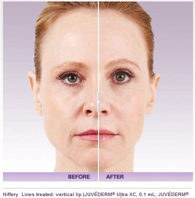 Fat Injections as Dermal Fillers | Beverly Hills Medical Spa