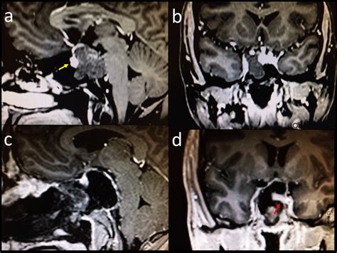 Contrast Enhanced T Weighted Mri Of Clival Chordoma Preoperative