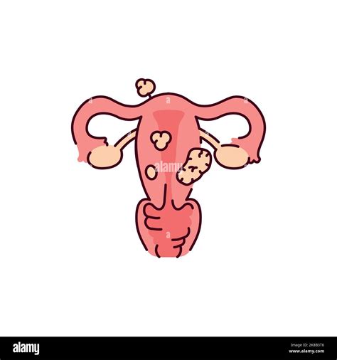 Uterine Myoma Color Line Icon Gynecology Problem Stock Vector Image