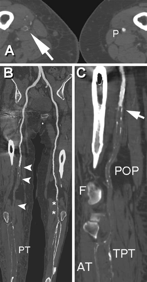 Acute Thrombosis Of The Femoropopliteal And Trifurcation Vessels In An