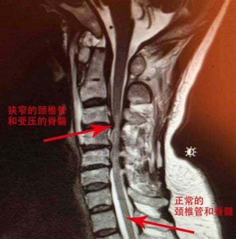 脊髓型頸椎病是最嚴重的頸椎病應該怎麼治療？ 每日頭條