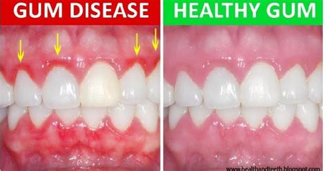 What Is Gingivitis Symptoms Causes And Prevention Health And Teeth