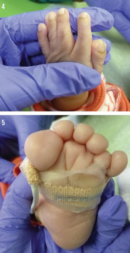 Pfeiffer Syndrome Hands And Feet