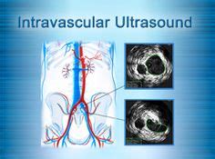 May-Thurner Syndrome