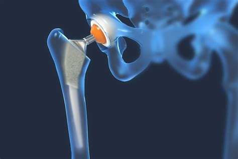 Med Journal Prosthetic Joint Infection Drug Granted Orphan Drug