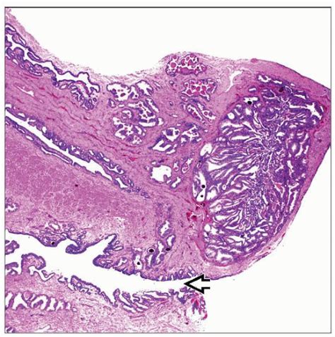 Verumontanum Mucosal Gland Hyperplasia Basicmedical Key