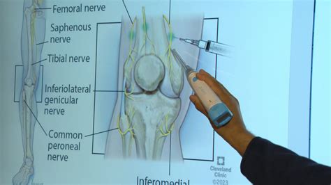 Reducing chronic knee pain before surgery helps recovery after