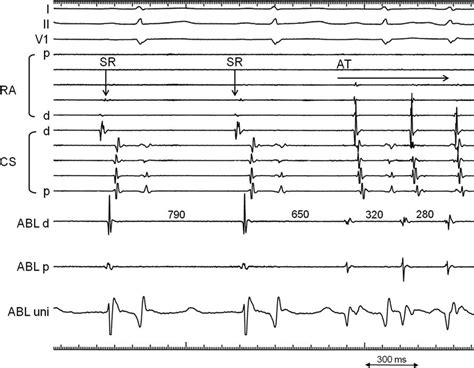 Body Surface Electrocardiograms And Intracardiac Electrograms In