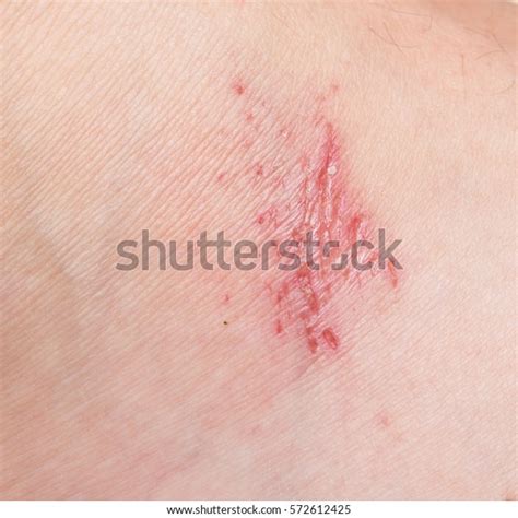 Wound On Human Skin Stock Photo Shutterstock