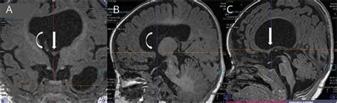 Mri Shows Membrane Obstructing Left Foramen Of Monro Download Scientific Diagram