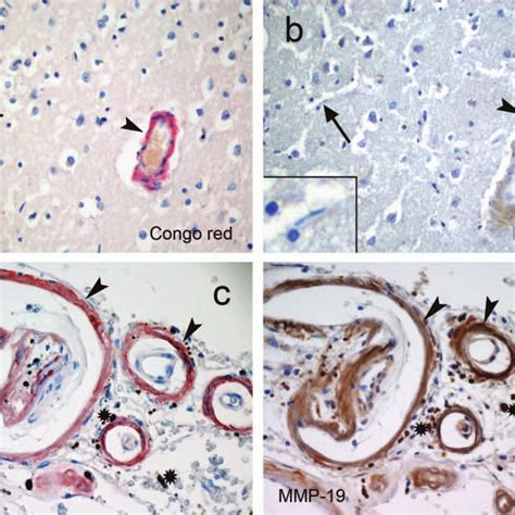 Amyloid The International Journal Of Experimental And Clinical