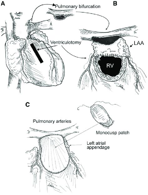 Operative Technique Of RV Pulmonary Artery PA Conduitless