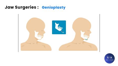 How To Get An Attractive Jawline : Surgery Edition