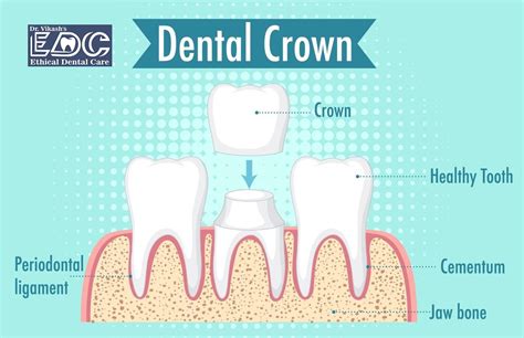 Ensure Healthy And Bright Smile With Dental Crown In Noida