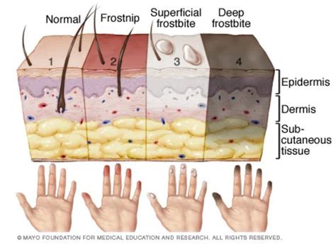 What Happens To Your Body In The Extreme Cold Beware Of Hypothermia