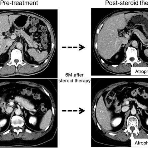 Typical Computed Tomography Images Of Atrophy Or Nonatrophy Cases