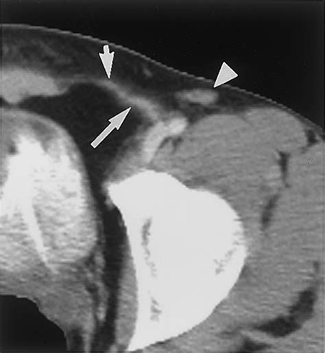 Imaging Of Groin Masses Inguinal Anatomy And Pathologic Conditions Revisited Radiographics