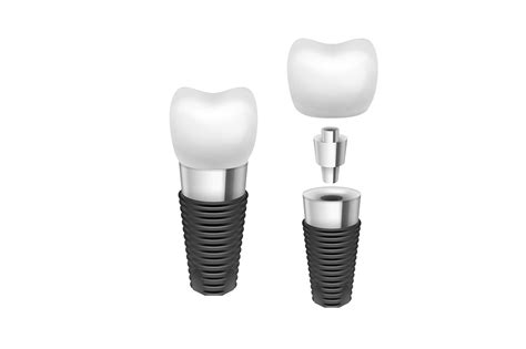 8 Most Common Questions About Dental Implants Growing Smiles