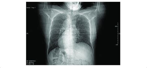 Chest X Ray Shows Dextrocardia In This Patient With Situs Inversus