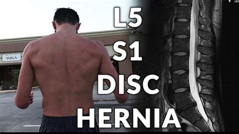 My L5 S1 Disc Hernia Miracle Cure (When Physical Therapy Is Just Not ...