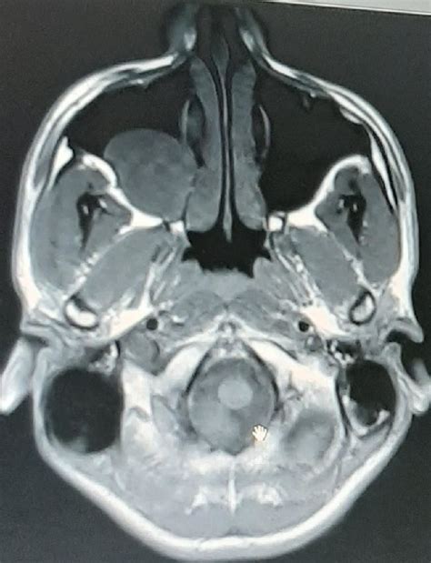 Maxillary Sinus Cyst Mri | The Best Porn Website